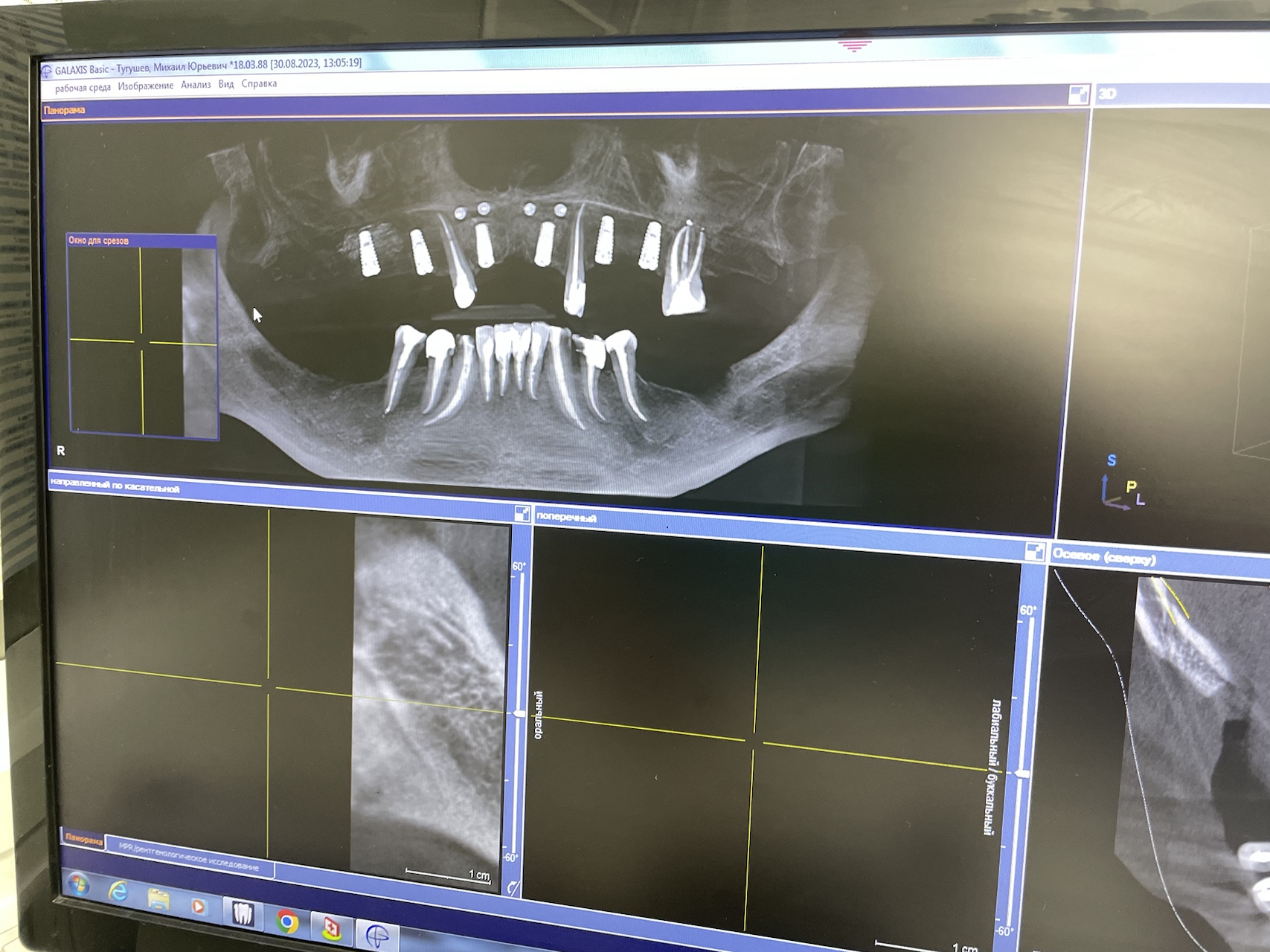 снимок установленных имплантов AnyOne в верхней челюсти